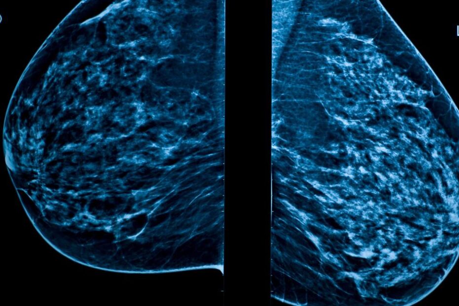 What is a mammogram