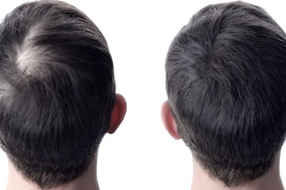 Hair Restoration From Carboxytherapy to Surgical Hair Transplants ()