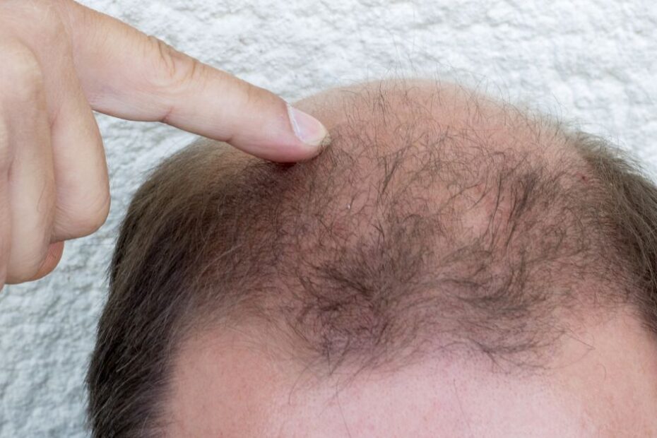 Hair Loss and Exploring Modern Treatments