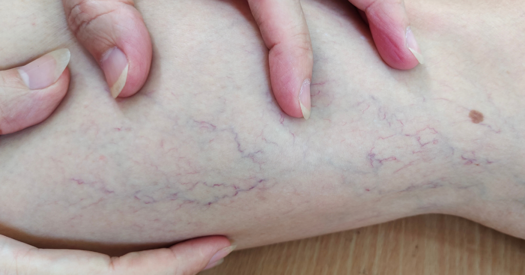 Varicose Veins