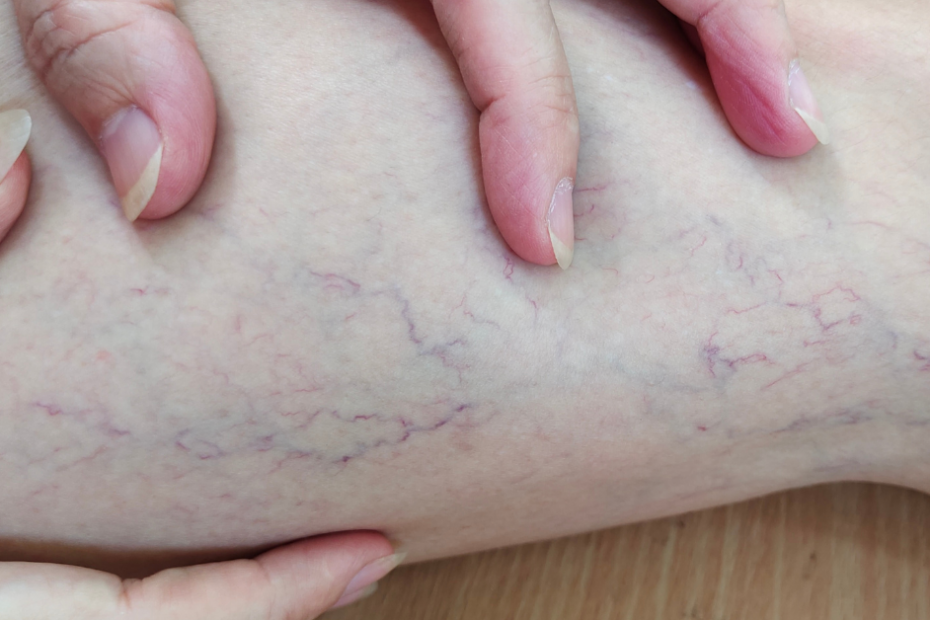 Varicose Veins