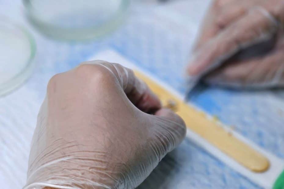 Detailed view of hair graft preparation during a hair transplant surgery.