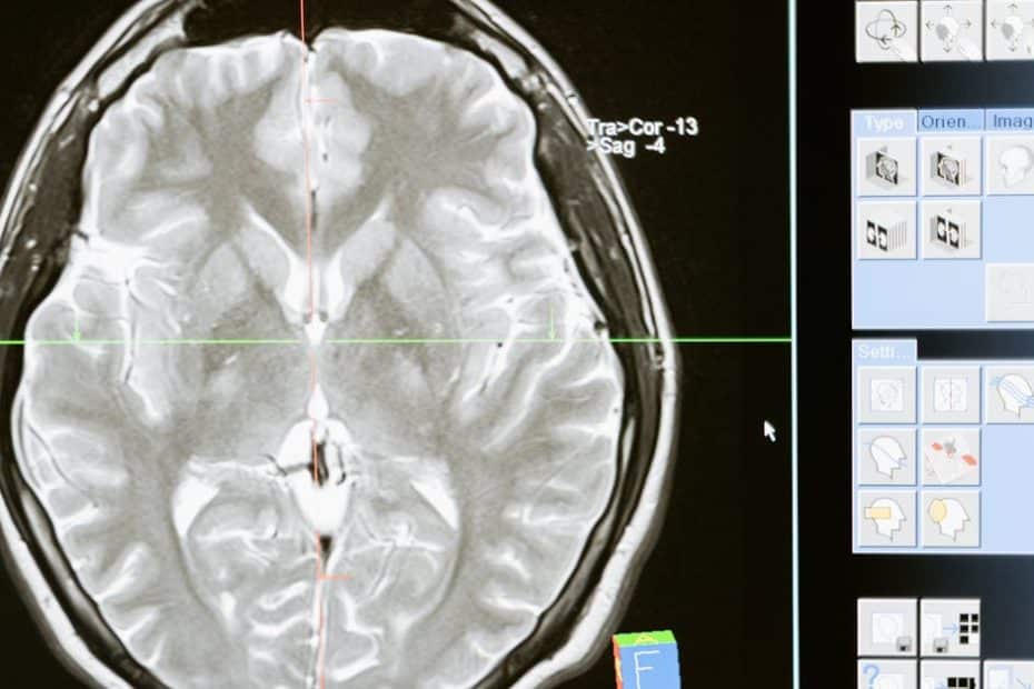 Intricate MRI brain scan displayed on a computer screen for medical analysis and diagnosis.